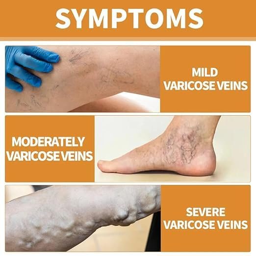 đEK K SAATH 1 MUFT LIMITED TIME OFFERđ„Turmeric Varicose Vein Relief Spray (100ML + 100ML) - Image 4