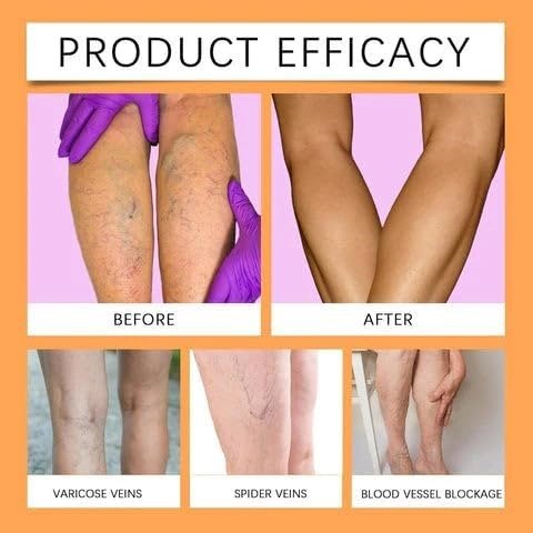đEK K SAATH 1 MUFT LIMITED TIME OFFERđ„Turmeric Varicose Vein Relief Spray (100ML + 100ML) - Image 3