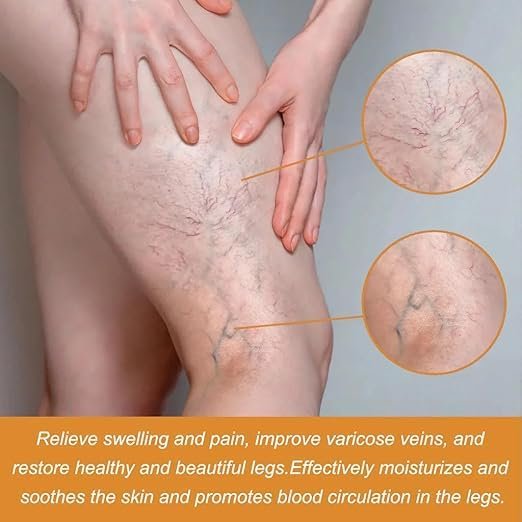 đEK K SAATH 1 MUFT LIMITED TIME OFFERđ„Turmeric Varicose Vein Relief Spray (100ML + 100ML) - Image 2